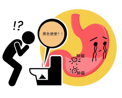 早期胃癌的隐形信号，超90%患者忽视的两大症状